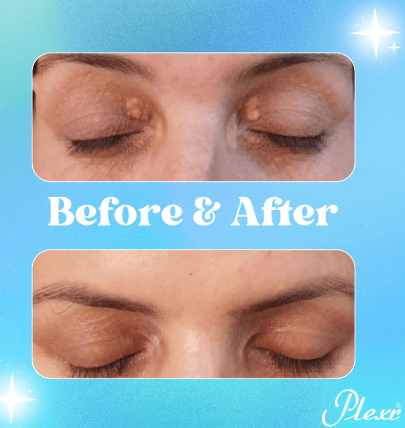 Eyelid Rejuvenation